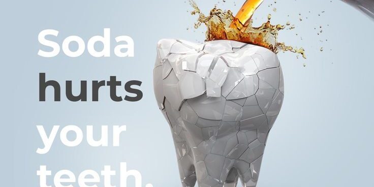 Soda causing enamel erosion and tooth decay due to sugar and acid