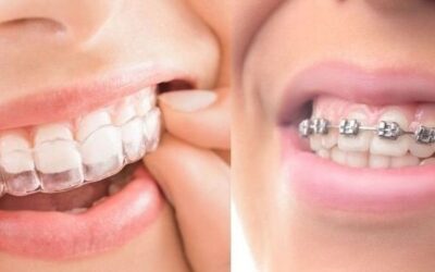 Clear Invisalign aligners used for discreet orthodontic teeth straightening treatment