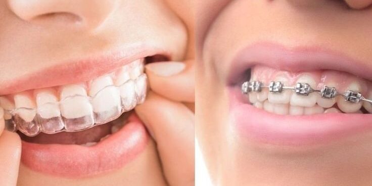 Clear Invisalign aligners used for discreet orthodontic teeth straightening treatment