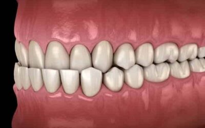 Deep Bite Dental Condition Illustration