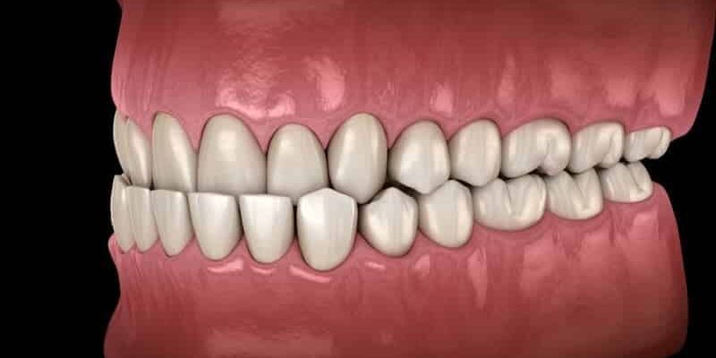 Deep Bite Dental Condition Illustration