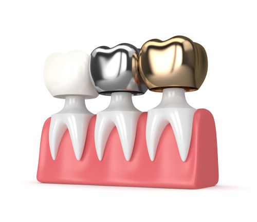 Comparison of metal, porcelain fused to metal, ceramic and zirconia dental crowns