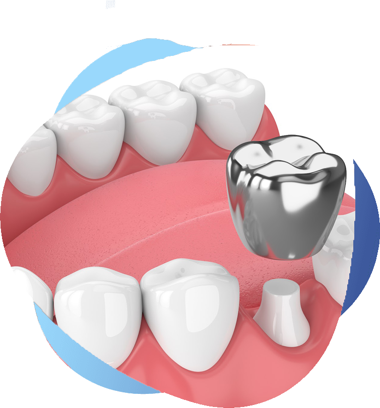 Dentist placing a tooth-shaped dental crown over a damaged or decayed tooth to restore its strength and appearance.