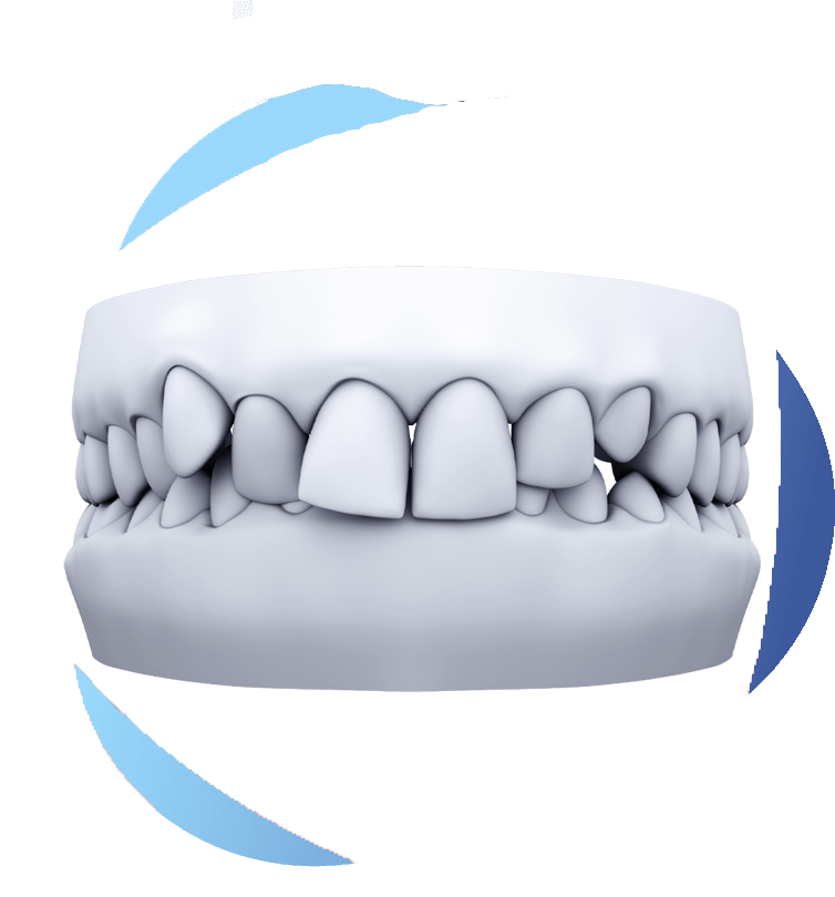 Dental diagram showing upper front teeth excessively overlapping lower front teeth, indicating a deep bite.