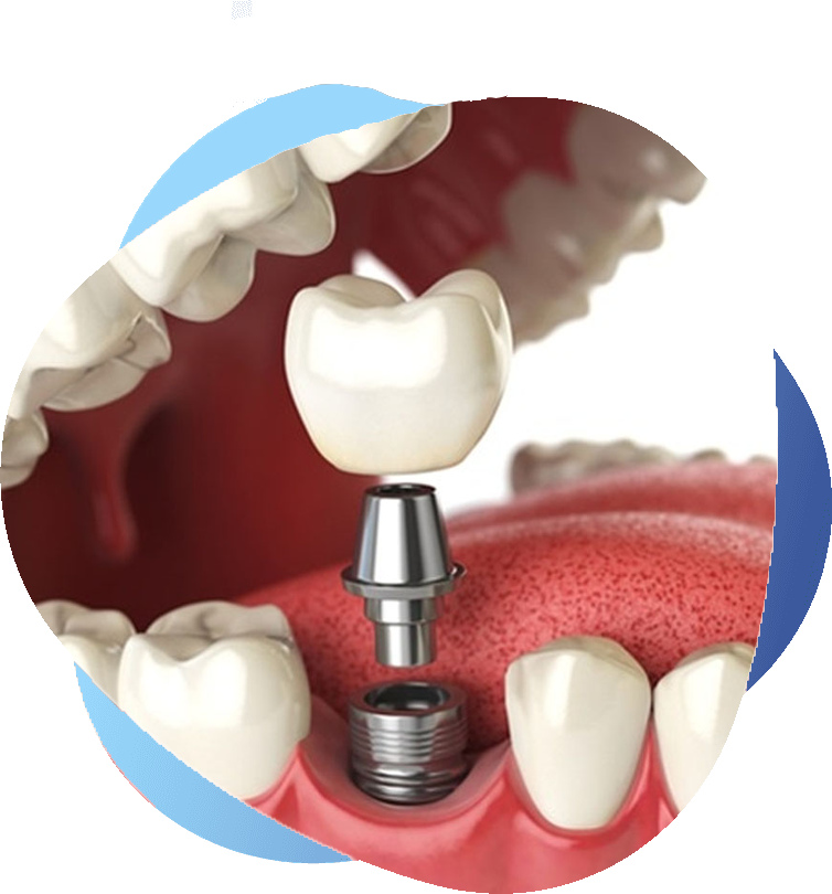 Dental diagram showing a dental implant placed in the jawbone with an abutment and crown replacing a missing tooth.