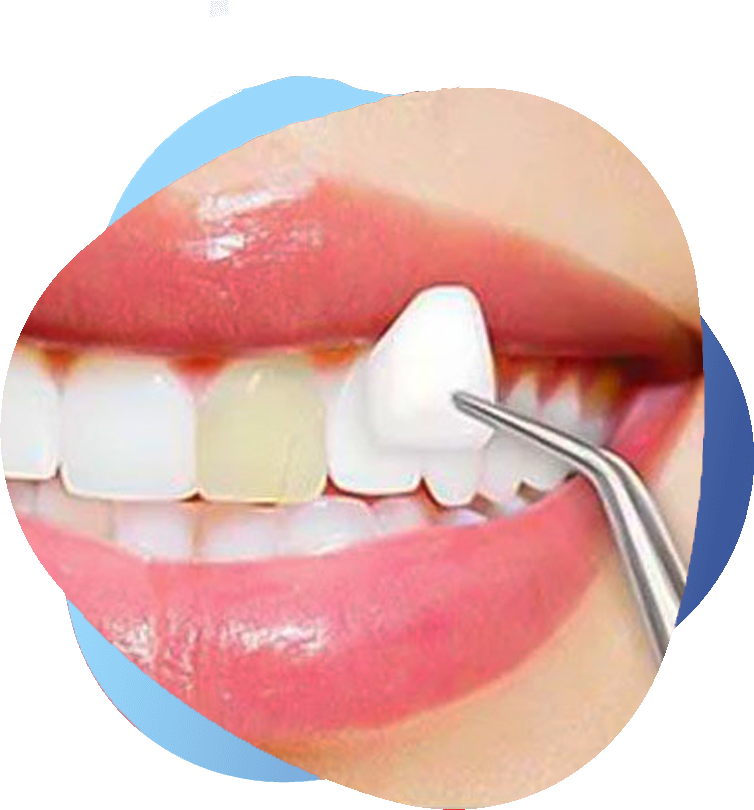 Close-up of a patient smiling with bright, evenly shaped teeth after dental laminate veneer treatment.