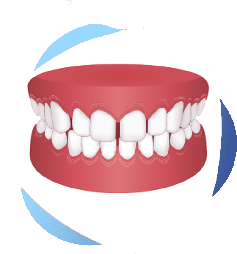 Close-up of a smile showing a visible gap between the two upper front teeth, known as a midline diastema.