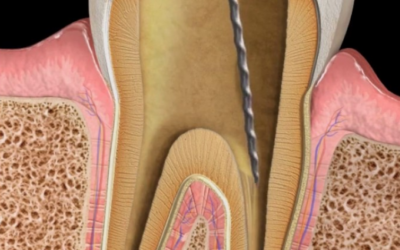 Apexification Procedure in Immature Permanent Tooth