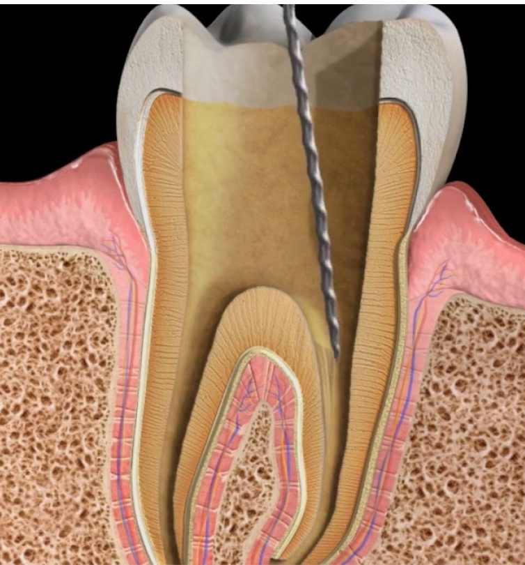 Apexification Procedure in Immature Permanent Tooth