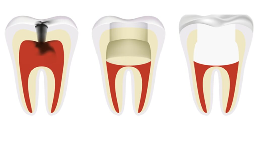 Pulpotomy procedure in children to treat infected baby tooth pulp