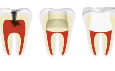 Pulpotomy procedure in children to treat infected baby tooth pulp