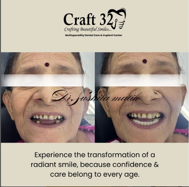 Teeth whitening treatment result showing brighter smile in Pune dental clinic