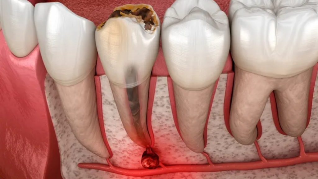 Apexogenesis procedure in an immature permanent tooth showing vital pulp therapy that allows continued root development and apex closure.