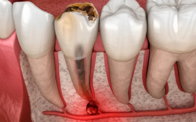 Apexogenesis procedure in an immature permanent tooth showing vital pulp therapy that allows continued root development and apex closure.