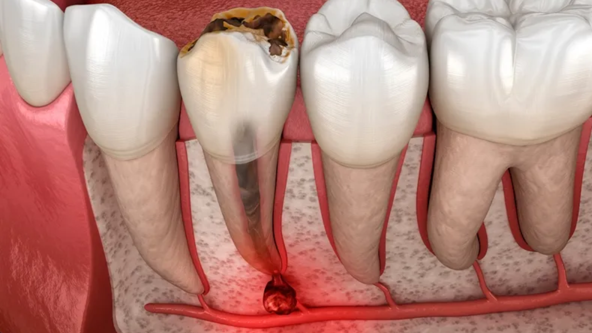Apexogenesis procedure in an immature permanent tooth showing vital pulp therapy that allows continued root development and apex closure.