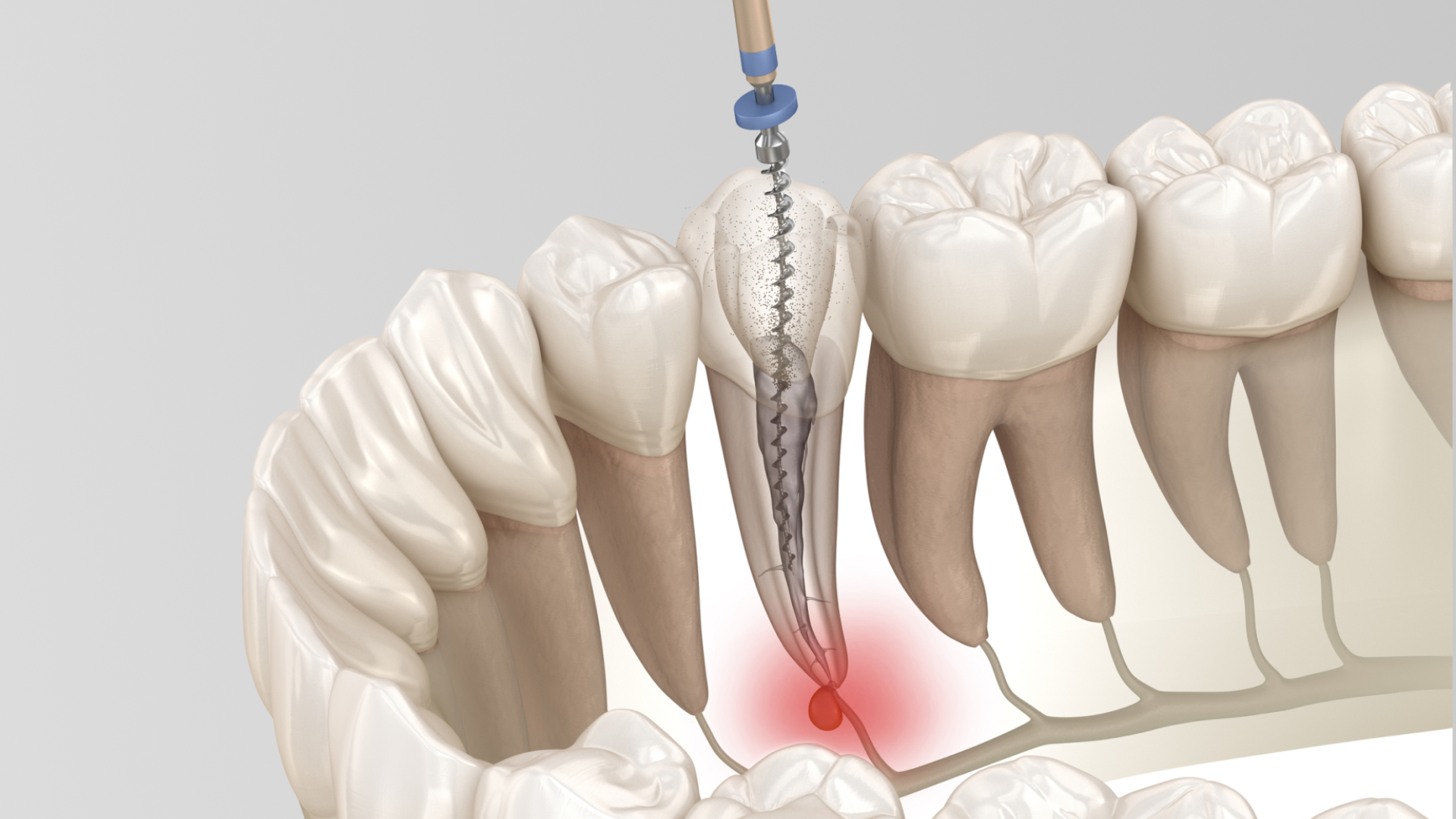 Dental diagram explaining root canal retreatment and cleaning of infected canals.