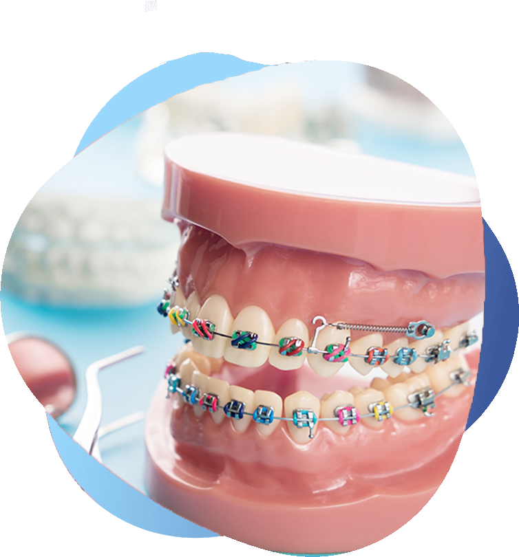 Close-up of a patient wearing metal braces used in orthodontic treatment to straighten misaligned teeth